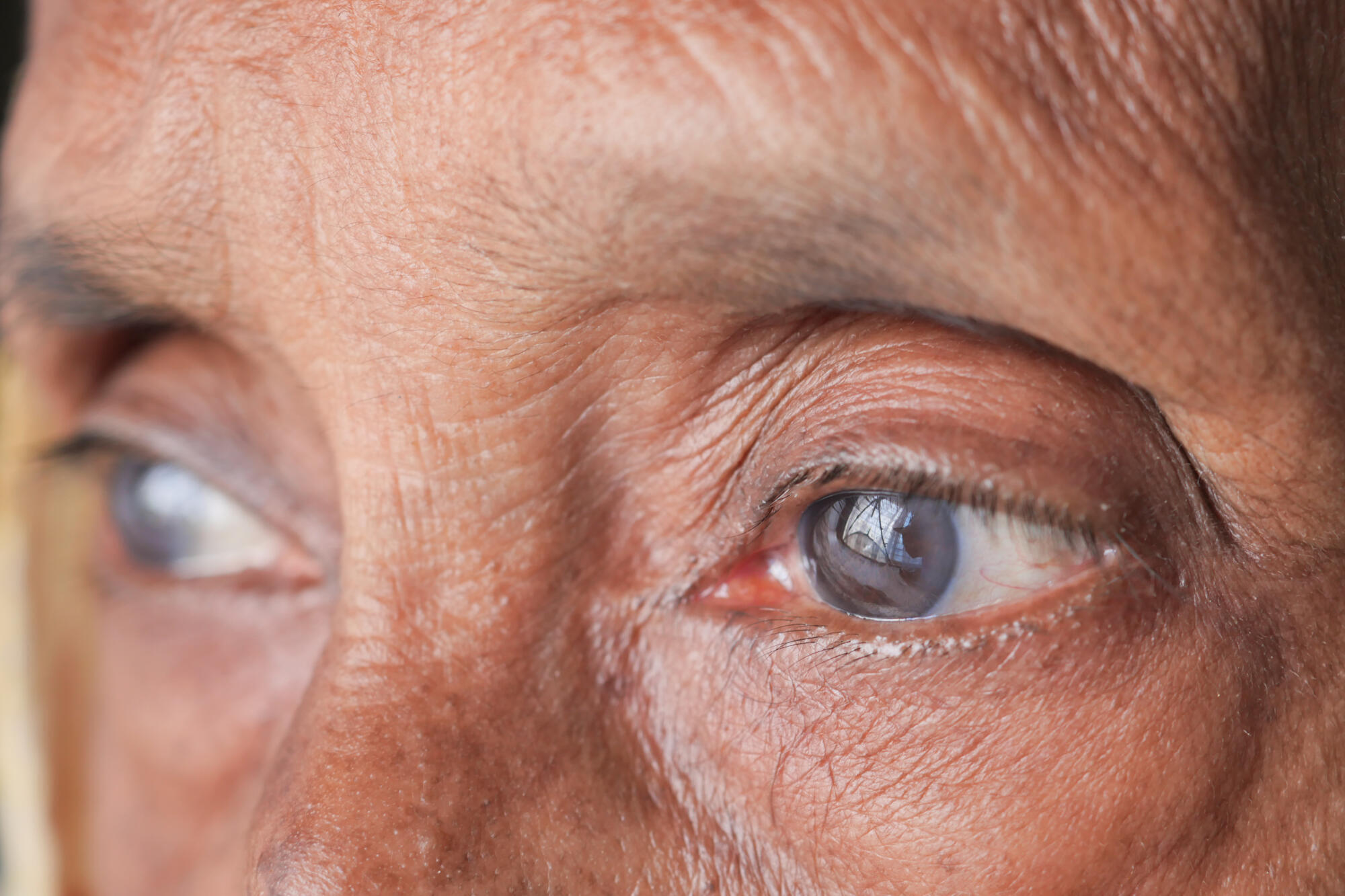 Diabetic Cataracts: What Lafayette Seniors Should Know